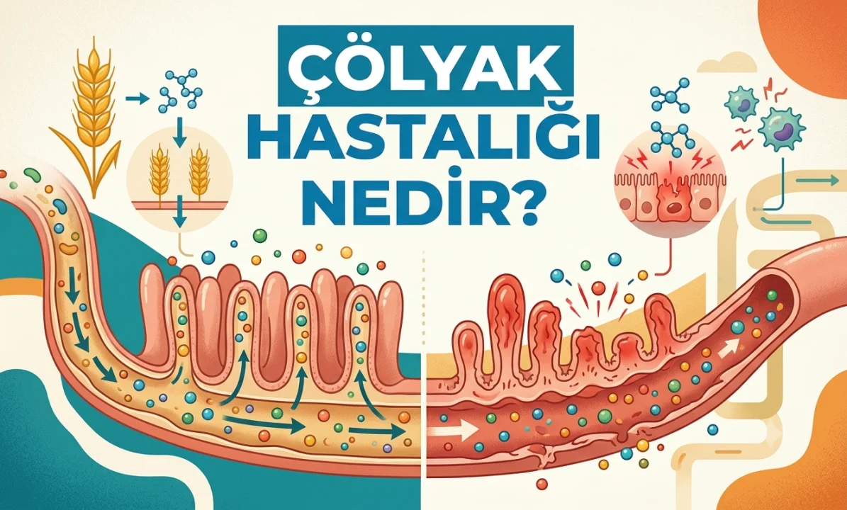 Çölyak Hastalığı Nedir?