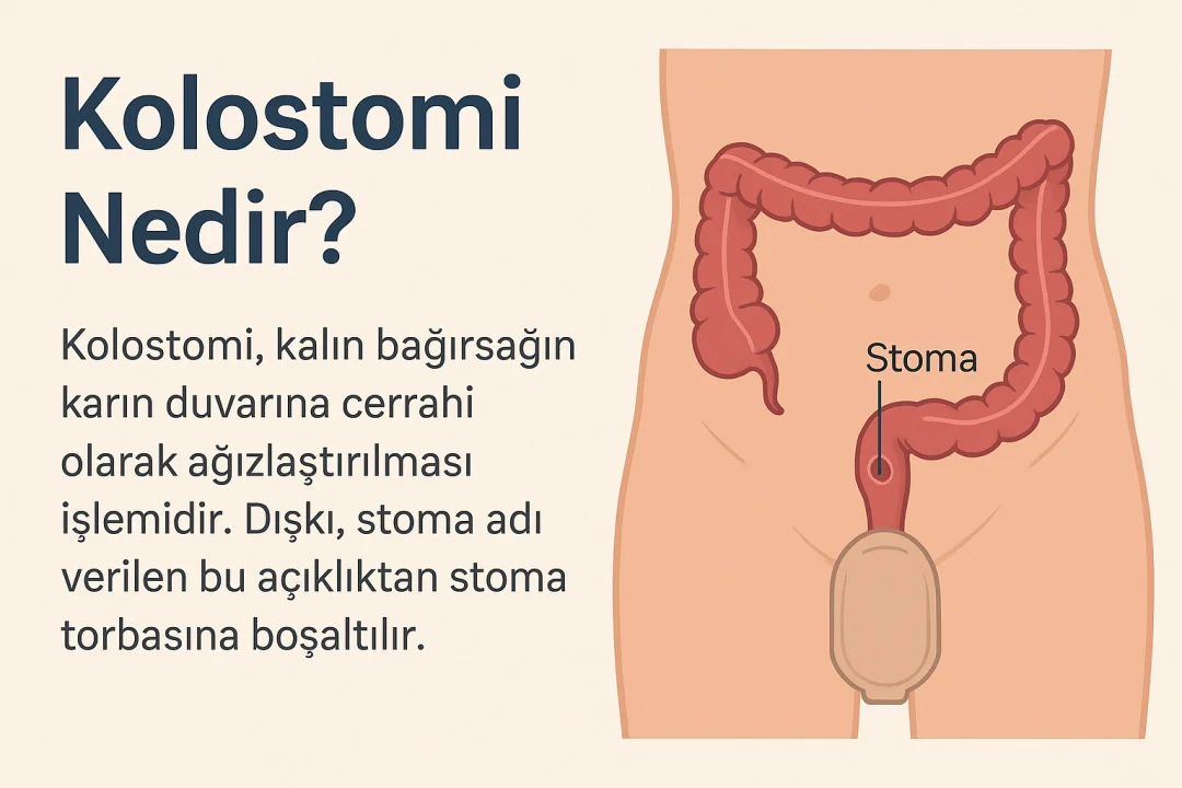 Kolostomi Nedir?